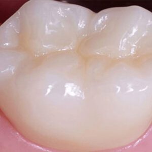 Tooth Colored Dental Fillings