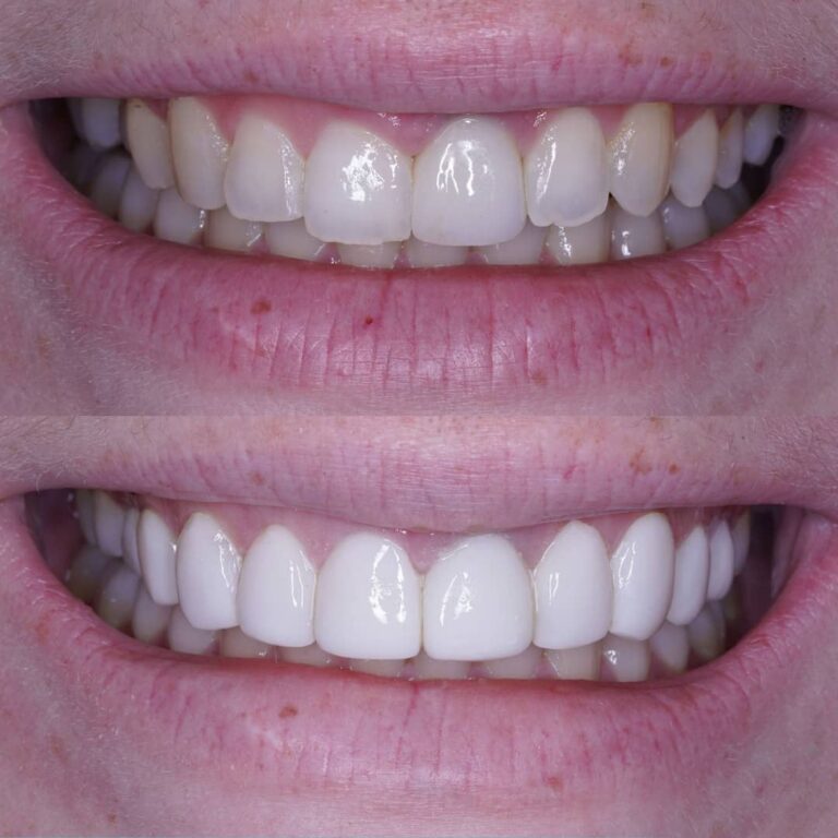 Best Porcelain Dental Veneers in Mexico Contact Pure Smile
