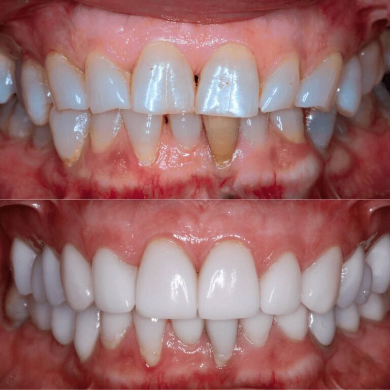 Best Porcelain Dental Veneers in Mexico Contact Pure Smile