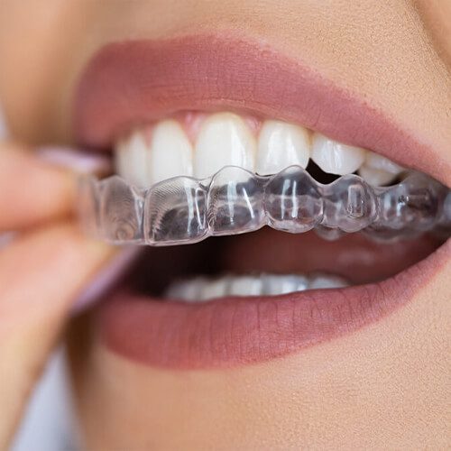 a person inserting clear aligners