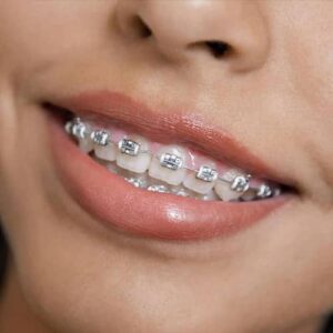 dental braces on smiling patient