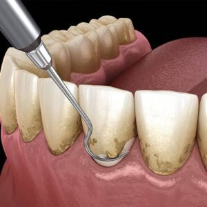 tooth scaling and root planing in Mexico