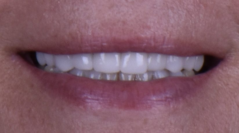 closeup of smile after cosmetic dental work