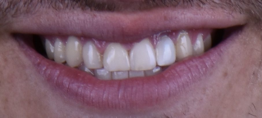 closeup of teeth before dental treatment