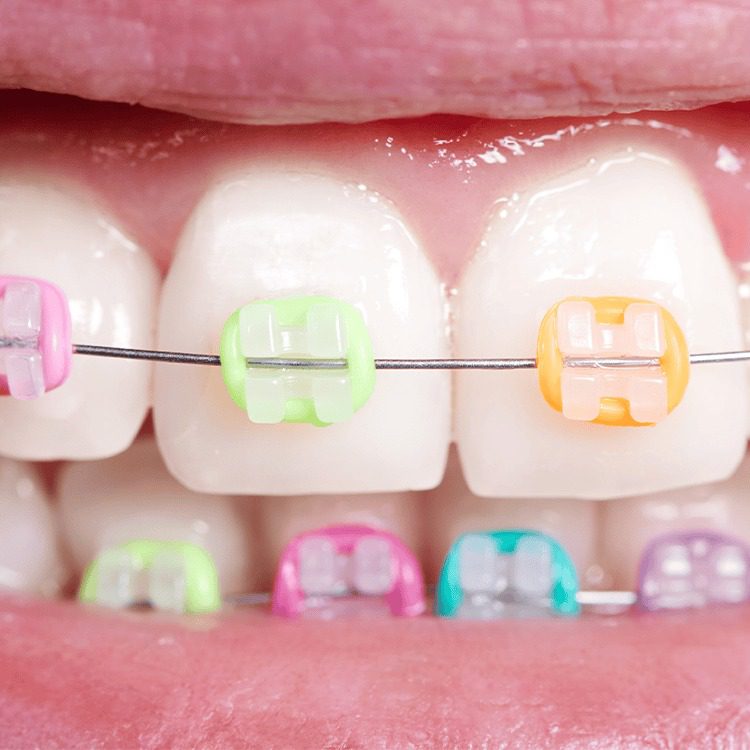 closeup of teeth with colorful braces