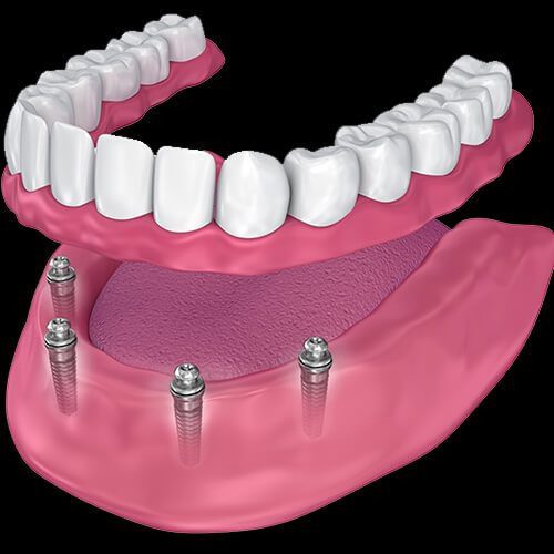 lower jaw model showing four titanium implants