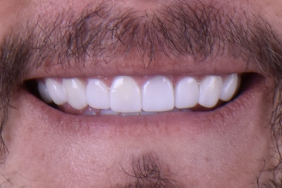 patient smiling after dental treatment