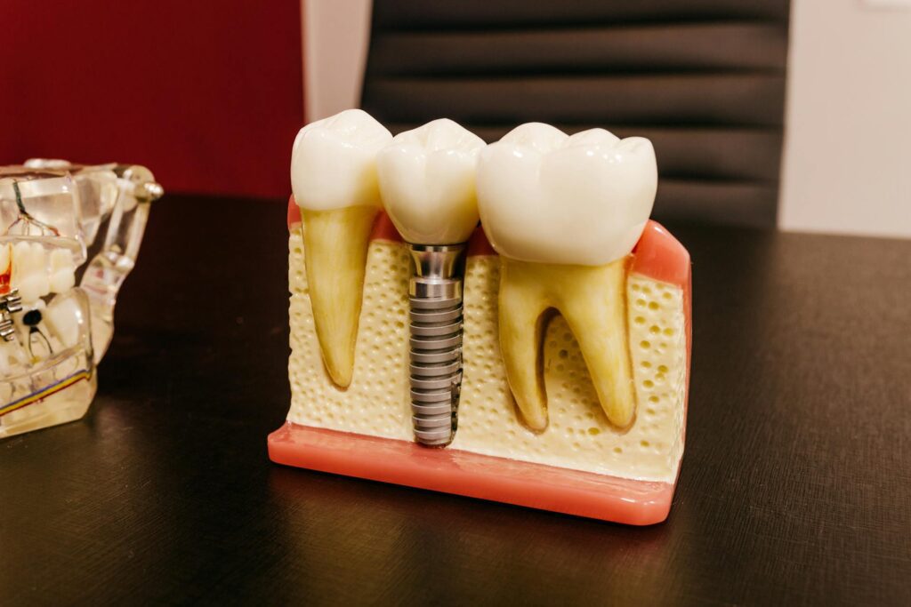 A model of a single dental implant