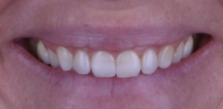 smile showing teeth before treatment