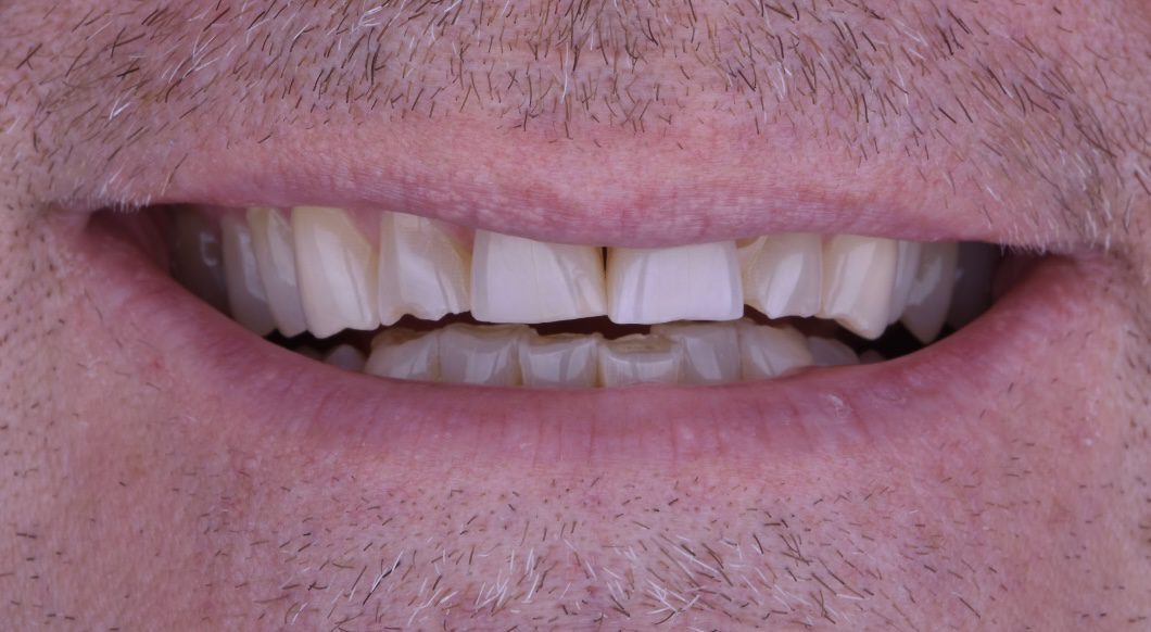 smile showing uneven discolored teeth