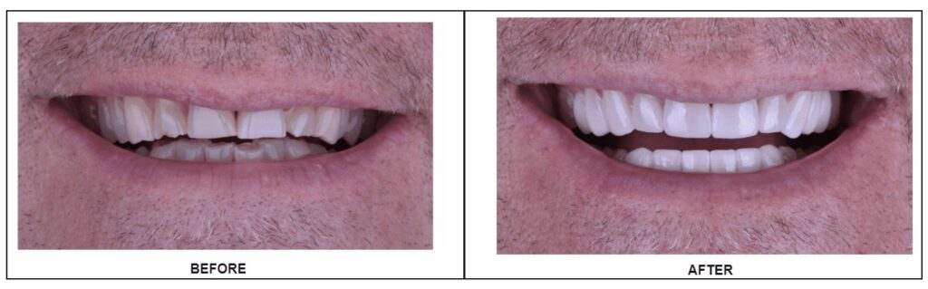 A close-up of a man showing off before and after results of veneer treatment